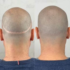 ازبین بردن خط بخیه